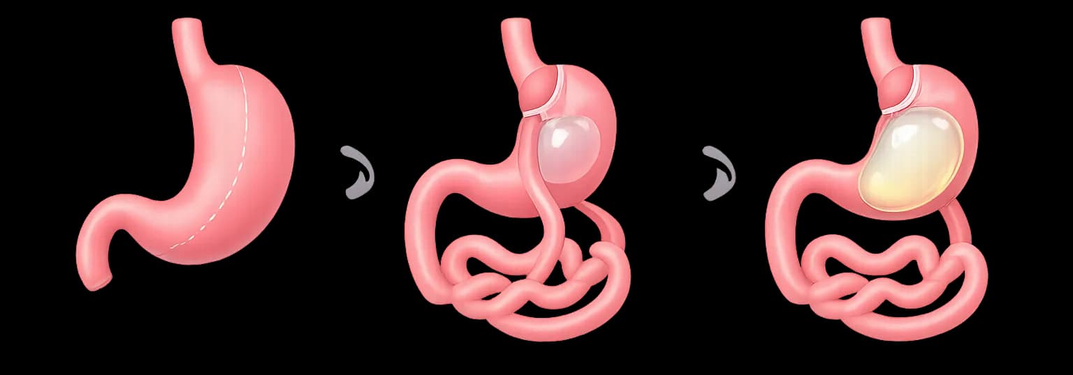 Gastric Balloon