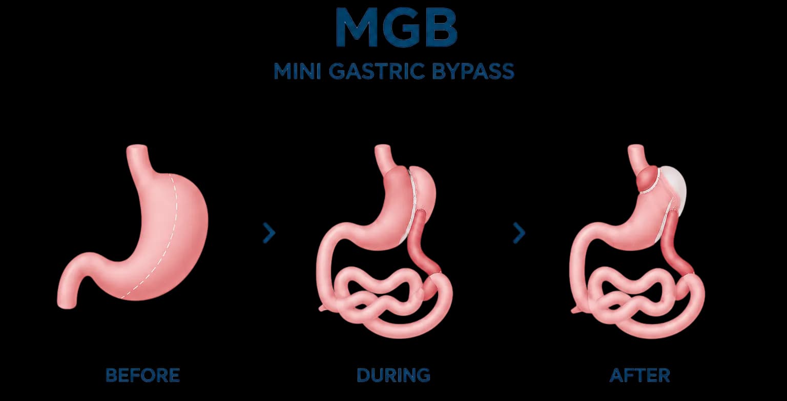 Gastric Bypass
