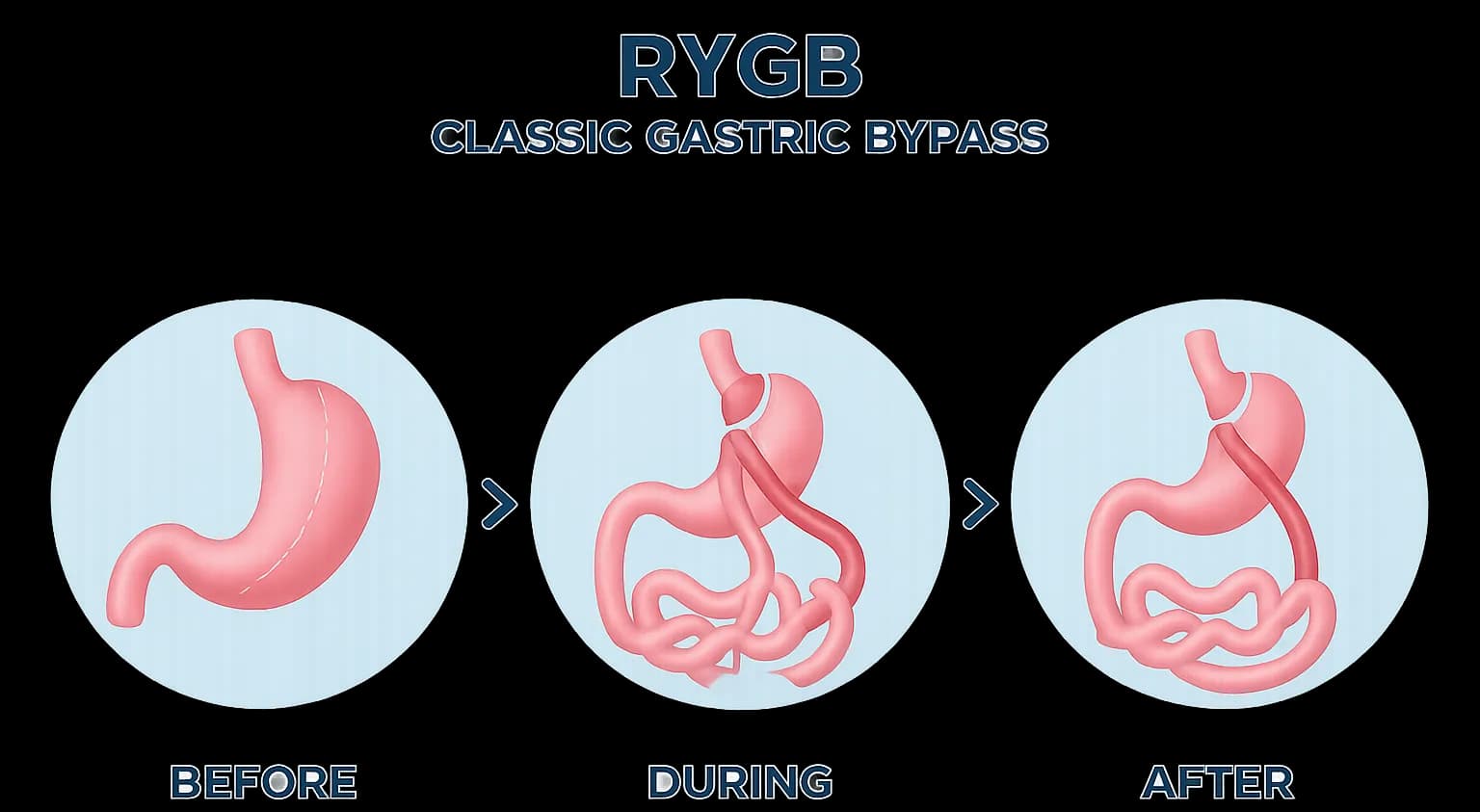 Gastric Bypass