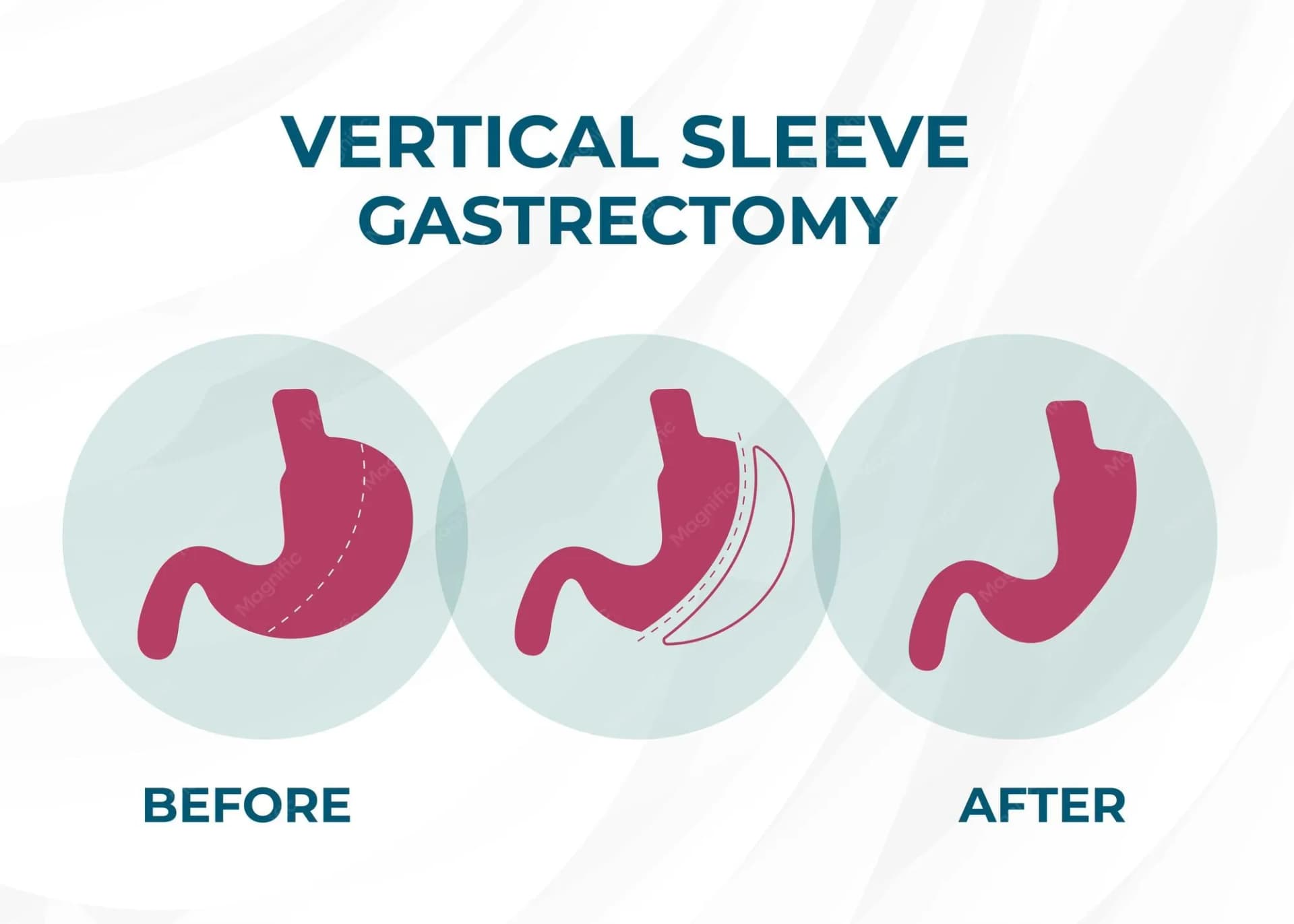 Sleeve Gastrectomy
