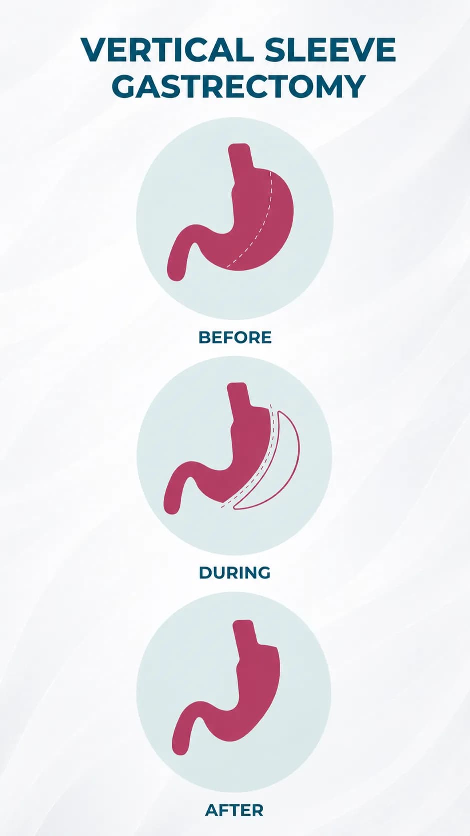 Sleeve Gastrectomy